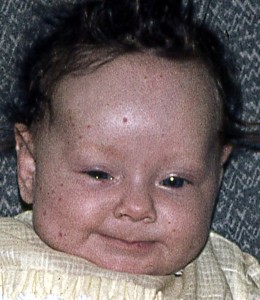donna aged 0.4 mths with measles